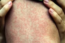 Điện Biên khuyến cáo chủ động phòng, chống bệnh sởi