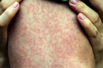 Điện Biên khuyến cáo chủ động phòng, chống bệnh sởi