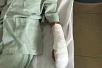 Cứu người phụ nữ 62 tuổi bị đứt động mạch quay do dao cắt