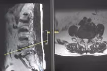 Nhờ phẫu thuật cột sống thức tỉnh, cụ ông 82 tuổi thoát liệt