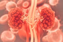 Phẫu thuật kịp thời giúp bệnh nhân thoát khỏi suy thận cấp do sỏi niệu quản