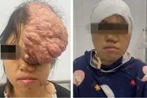 Cô gái trẻ phải sống trong mặc cảm, đau đớn vì khối u khổng lồ đỉnh trán