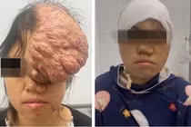 Cô gái trẻ phải sống trong mặc cảm, đau đớn vì khối u khổng lồ đỉnh trán