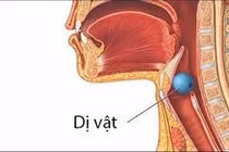 Phát hiện dị vật trong phế quản của người phụ nữ 50 tuổi