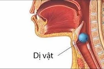 Phát hiện dị vật trong phế quản của người phụ nữ 50 tuổi