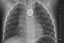 Bé trai gần 3 tuổi loét thực quản vì nuốt phải pin cúc áo 
