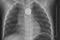 Bé trai gần 3 tuổi loét thực quản vì nuốt phải pin cúc áo 