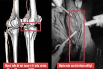 Cứu chân phải của chàng trai bị chấn thương nặng do tai nạn giao thông