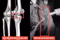 Cứu chân phải của chàng trai bị chấn thương nặng do tai nạn giao thông