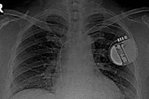 Thiết bị phá rung tim, cứu sống người bệnh mắc hội chứng tái cực sớm