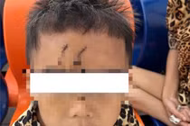 Cấp cứu cho bé trai ở TP HCM bị chó béc-giê cắn biến dạng mặt 