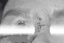 Người đàn ông bị dị vật kim loại đâm vào mắt