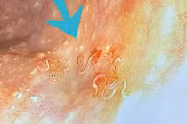 Người phụ nữ 63 tuổi phát hiện nhiều giun ký sinh trong đại tràng