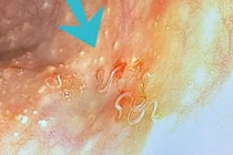 Người phụ nữ 63 tuổi phát hiện nhiều giun ký sinh trong đại tràng