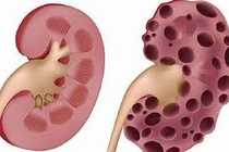 Lạm dụng thuốc giảm cân, giảm đau khiến thận tổn thương 