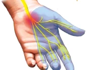 Y học cổ truyền trong điều trị hội chứng ống cổ tay