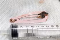 Bé 6 tuổi nuốt kẹp tóc kim loại nguy hiểm được cấp cứu kịp thời