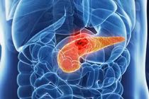 Quảng Ninh điều trị thành công viêm tụy cấp nặng do tăng triglycerid máu