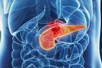 Quảng Ninh điều trị thành công viêm tụy cấp nặng do tăng triglycerid máu