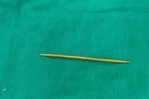 Cứu sống người phụ nữ nuốt tăm tre xuyên thủng đại tràng