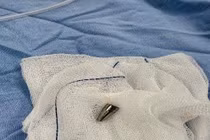 Bé 7 tuổi thoát chết nhờ cấp cứu dị vật đường thở thành công