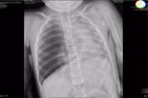 Hai trẻ nhập viện cấp cứu vì hóc dị vật nguy hiểm tại Quảng Ninh