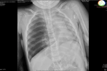 Hai trẻ nhập viện cấp cứu vì hóc dị vật nguy hiểm tại Quảng Ninh