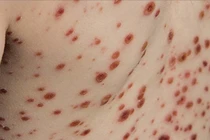 Bệnh viện Đa khoa Hà Giang tiếp nhận nhiều ca thủy đậu biến chứng nặng