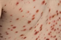 Bệnh viện Đa khoa Hà Giang tiếp nhận nhiều ca thủy đậu biến chứng nặng