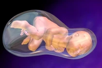 Sinh đôi hiếm gặp, bé thứ hai còn nguyên trong túi ối 