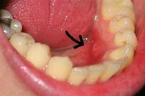 Dấu hiệu ban đầu của ung thư khoang miệng