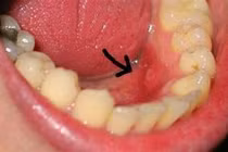 Dấu hiệu ban đầu của ung thư khoang miệng