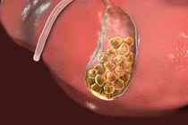 Phẫu thuật thành công cho bệnh nhân viêm tụy cấp do sỏi túi mật
