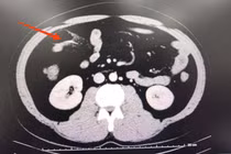 Người đàn ông thủng ruột non do dị vật tăm tre