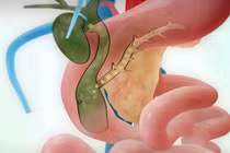 Bệnh gan mật hiếm gặp ở trẻ nhỏ được điều trị thành công tại Hải Phòng