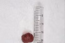 Bệnh viện Phú Thọ thành công loại bỏ polyp đại tràng lớn cho bé trai 13 tuổi