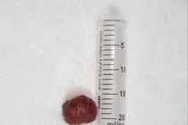 Bệnh viện Phú Thọ thành công loại bỏ polyp đại tràng lớn cho bé trai 13 tuổi