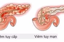 Nguy cơ viêm tụy cấp tăng cao dịp Tết do rượu bia, chế độ ăn không hợp lý
