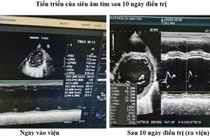 Bệnh nhi 11 tuổi thoát nguy kịch nhờ phác đồ điều trị suy tim mới