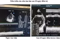 Bệnh nhi 11 tuổi thoát nguy kịch nhờ phác đồ điều trị suy tim mới