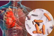 Phát hiện một hợp chất đột phá mang tên CMX410 có thể điều trị bệnh lao 