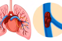 Cấp cứu thành công người bệnh thuyên tắc phổi nguy kịch