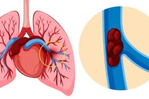 Cấp cứu thành công người bệnh thuyên tắc phổi nguy kịch