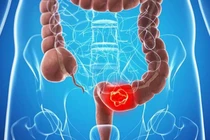 Cứu sống bệnh nhân thủng đại tràng sigma nguy kịch nhờ phẫu thuật nội soi