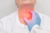 Một bệnh nhân được chẩn đoán mắc u nang giáp móng hiếm gặp