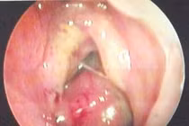 Phát hiện ca u xơ vòm mũi họng hiếm gặp ở thiếu niên 14 tuổi