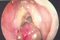 Phát hiện ca u xơ vòm mũi họng hiếm gặp ở thiếu niên 14 tuổi