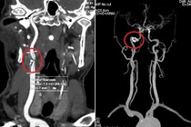 Phát hiện hẹp động mạch cảnh nặng đe dọa đột quỵ ở bệnh nhân tuổi trung niên