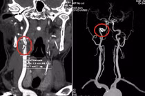 Phát hiện hẹp động mạch cảnh nặng đe dọa đột quỵ ở bệnh nhân tuổi trung niên