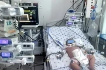 Bệnh nhi 7 tháng tuổi sốc sốt xuất huyết nặng phải nhập viện